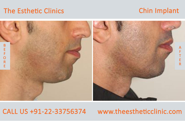 chin Augmentation, chin Implants surgery before after photos in mumbai india (2)